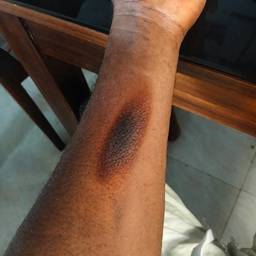 Burnt Arm Photo Edit