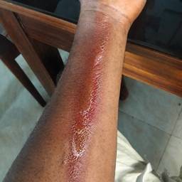 Realistic Burn Mark Edit