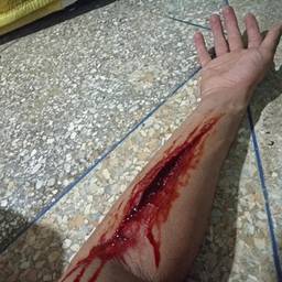 After - Realistic Arm Wound Effect