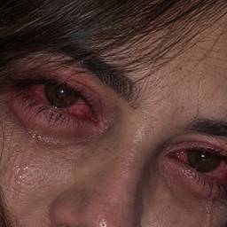 After - Bloodshot Eye Effect