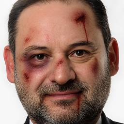 Nachher - Realistische Verletzungs-Fotobearbeitung