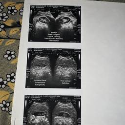 Kidney Failure Ultrasound Edit