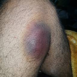 Depois - Edição de Foto Realista de Hematoma