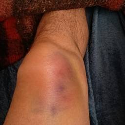 Depois - Joelho inchado e roxo