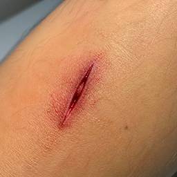 Puncture Wound Illustration