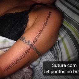 54 Stitches Arm Edit