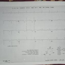 Avant - Modifier la Date d'ECG